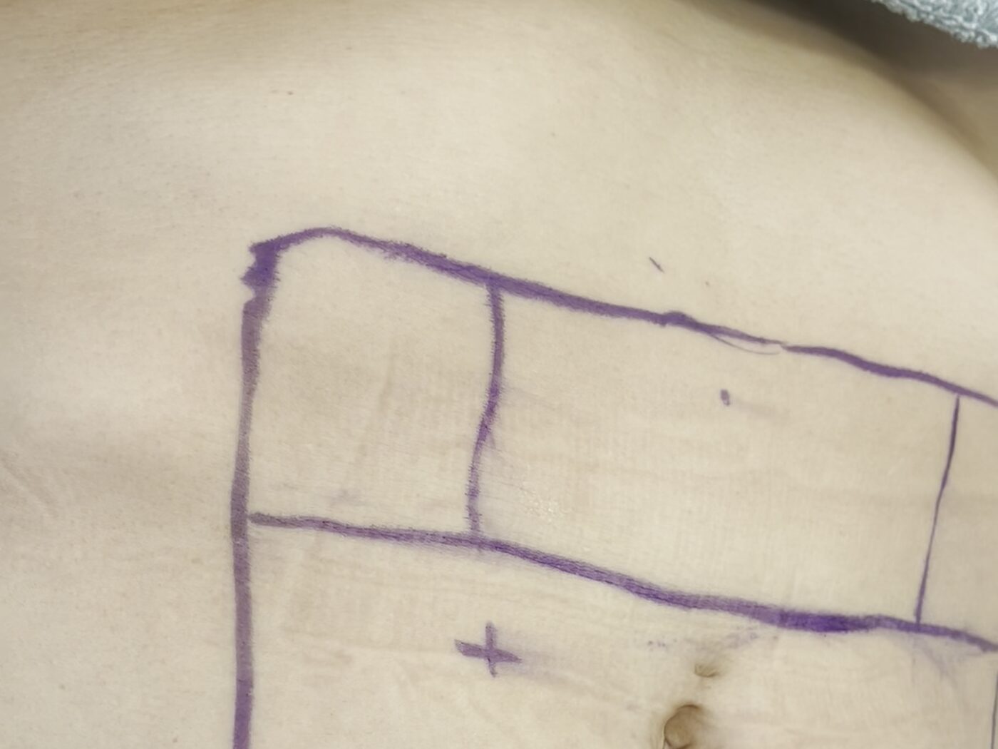Abdomen marcado con rotulador quirúrgico antes de iniciar el procedimiento